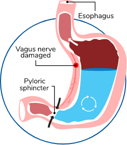 Illustration of the internal workings of a stomach with gastroparesis
